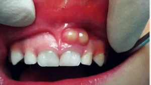 Gum Abscess