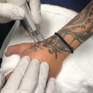 Tattoo Removal Technique